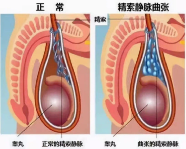【健康英山】显微微创技术帮助患者告别精索静脉曲张困扰