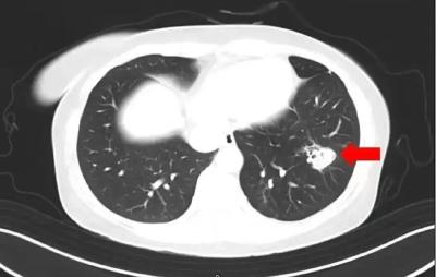 跟随家人扫房子后，女孩脑部被感染！春节大扫除，这些要注意