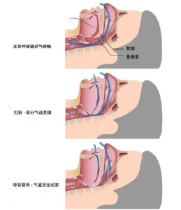 这项医疗技术想让2亿中国人睡个好觉 湖北医工融合让更多医生的“好点子”变成现实