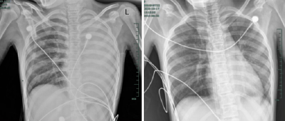发热仅1天，肺全白了！医生：极度危险，千万别当普通感冒