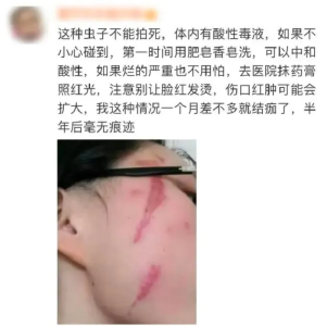 毒液堪比硫酸！一地确诊200多例！这份防护指南请收好