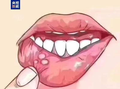 男子口腔溃疡两月没好查出癌症晚期 口腔出现这些信号别忽视