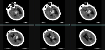 崇阳县人民医院：老人脑出血命悬一线  神经内镜大显身手