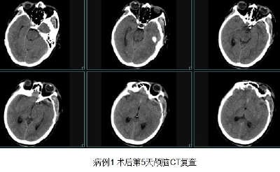 崇阳县人民医院神经外科成功开展颅内动脉瘤夹闭术