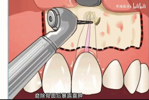 牙龈肿痛出血，真不是“上火”！拖久了可能要开刀  