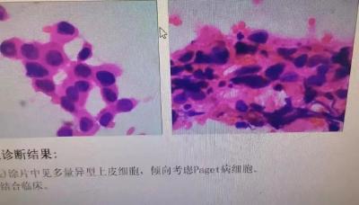 以为是湿疹，结果竟是癌！医生：很多患者去错科室