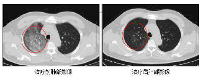 紧急提醒！发现1例！极为罕见