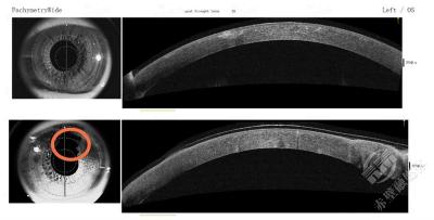 男子被小狗一爪拍破角膜，就医才知角膜早已发生变性