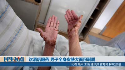 【民生视点】饮酒后服药 男子全身皮肤大面积剥脱