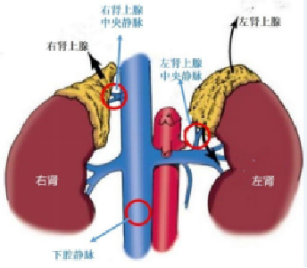 新突破！市中心医院成功开展江汉地区首例肾上腺静脉取血术