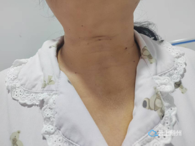 告别颈部“自杀式”疤痕，甲状腺手术进入“隐痕”新时代