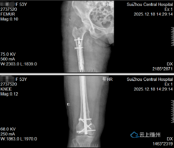 骨折手术不开大口？微创“针”功夫，治疗骨折有新招