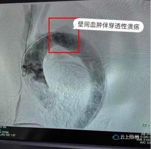 破解“主动脉危机”——曾都区人民医院心血管内科巧用分支支架，为七旬老人拆除血管“炸弹”