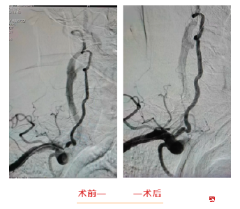 【越•广水】广水一医院神经内科独立完成首例椎动脉支架植入术