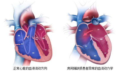 巨大房缺!十堰人医介入“放伞”成功补心