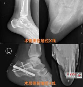 十堰人医应用“跟骨钉中钉”微创技术助骨折患者快速康复