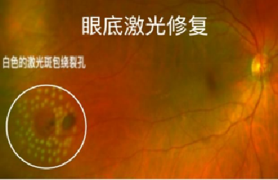 眼睛里也会出现“小井盖”？