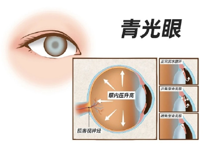 世界青光眼周 | 关于青光眼还需了解这些……