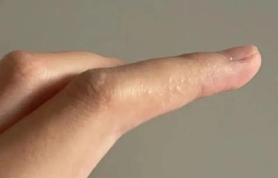汗疱疹会传染、挤破好得快？全是谣言！正确护理看这里